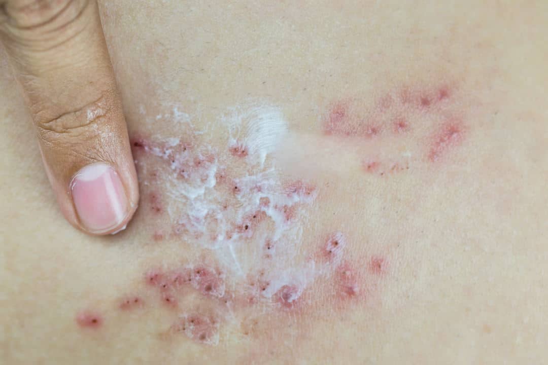 What Does Shingles Look Like? Appearance, Symptoms, and Causes